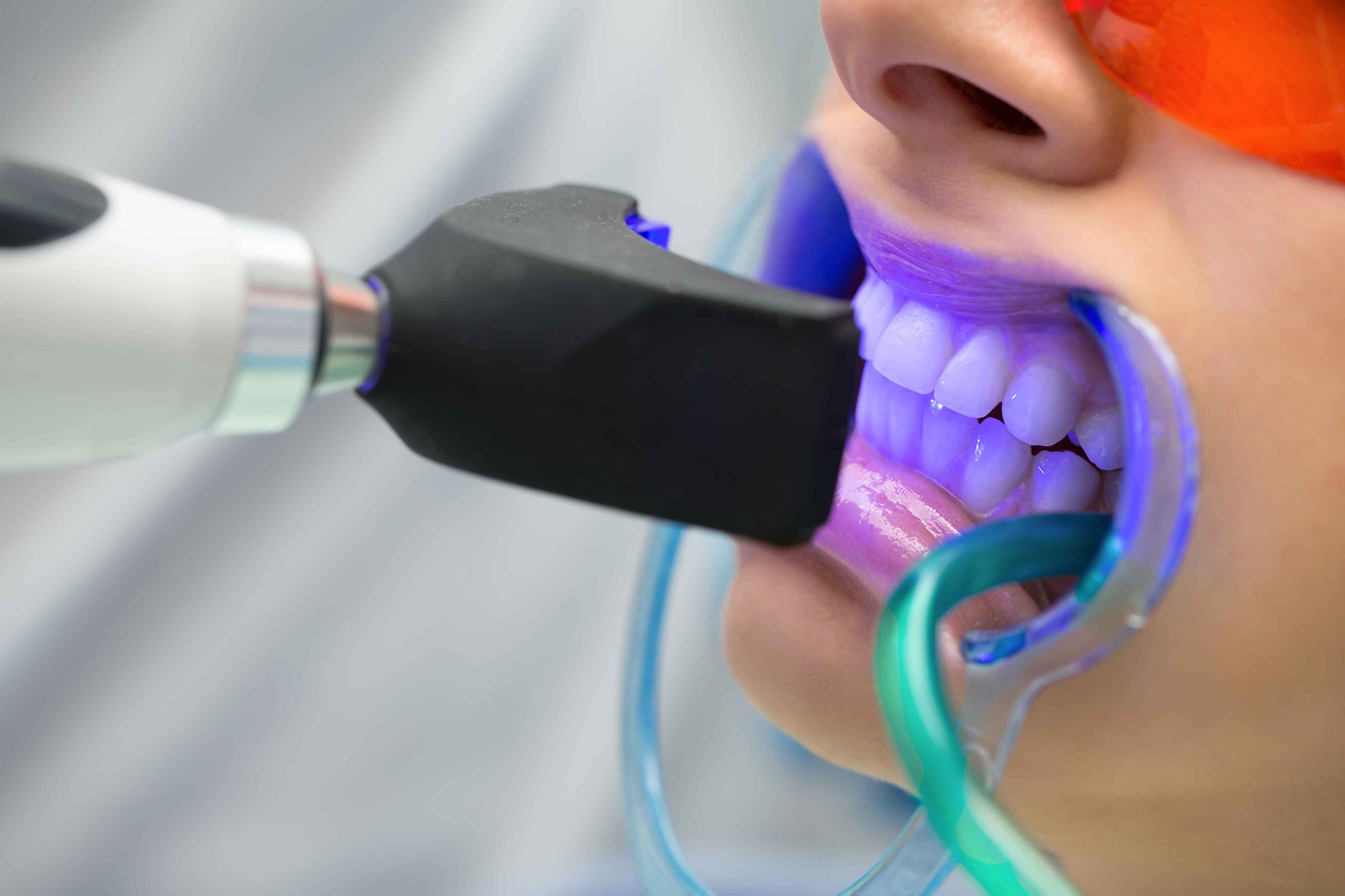 Teeth Whitening In-Chair - North Coast Dentists | Fresh Dental Care